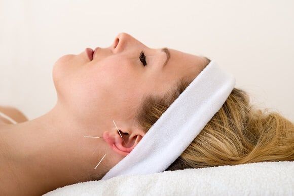Akupunktur tedavisi kulak normal akupunktur iğnesi görseli