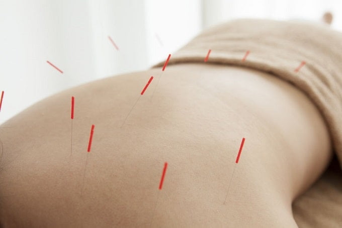 Akupunktur bağımlılık tedavisi vücut akupunktur görseli