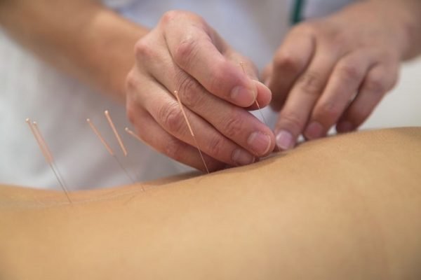 Akupunktur migren tedavisi sırt bölgesi