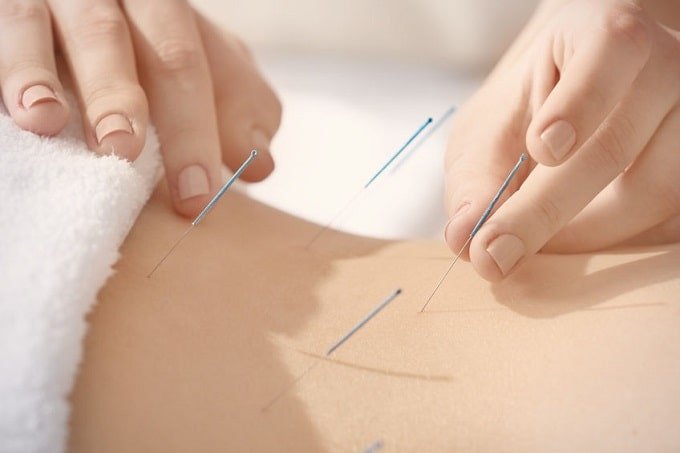 Akupunktur bağımlılık tedavisi