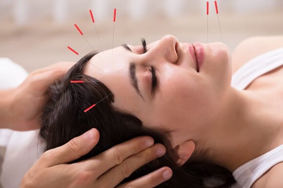 Vücut Akupunkturu yüz uygulaması